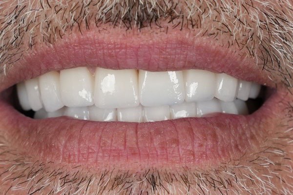 Laminat-Veneers – nachher